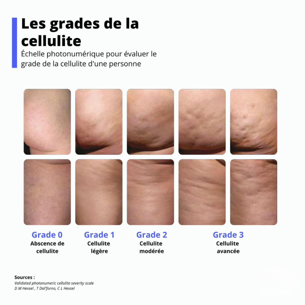 Centre de Cryolipolyse à Toulouse - Traitement par le froid